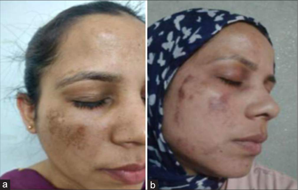 (a) Before and (b) after images of hyperpigmentation after glycolic acid (GA) peeling.