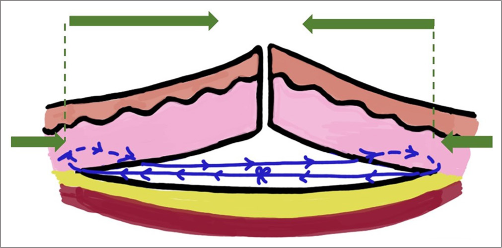 Push-Pull suture moving the pull vector laterally to cause pushing together of the wound margins. Short green arrow: Pull vectors, Long green arrows: Push vectors, Blue line: Suture material.