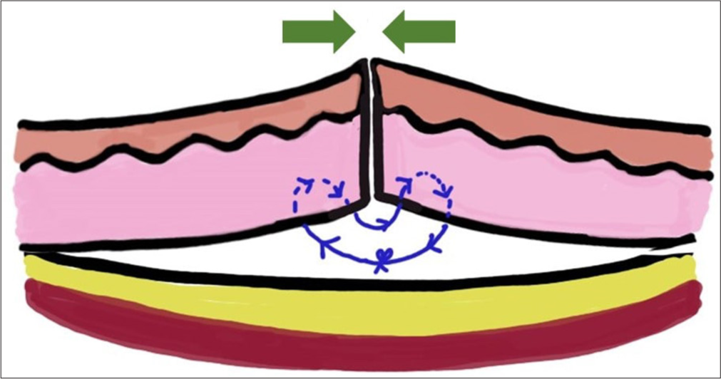 Diagrammatic representation of set-back suture, causing eversion but retaining the pull vector at the wound line. Short green arrow: Pull vectors, Blueline: Suture material.