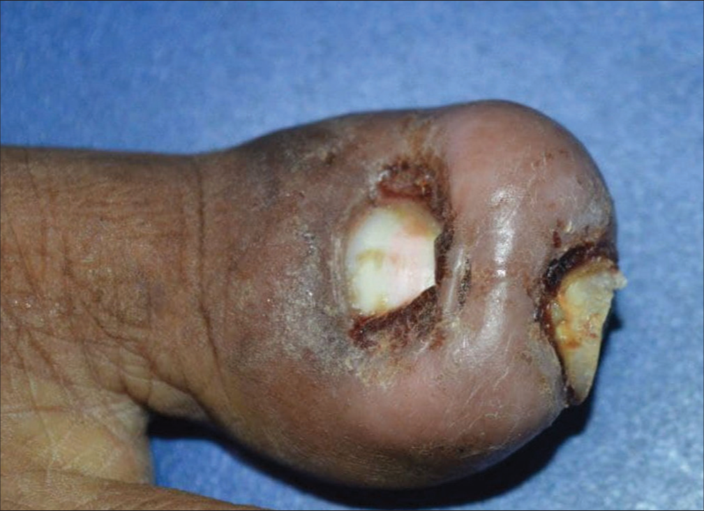 Dorsal view of the left hallux showing hypertrophic nail folds covering the distal nail plate.