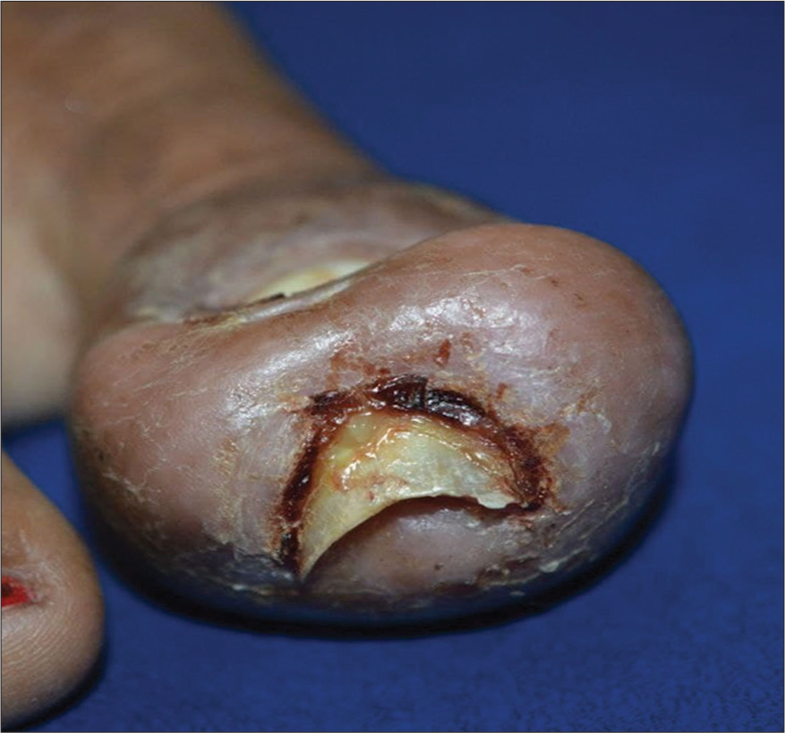 Frontal view of the left hallux showing granulation tissue and extended nail plate distally.