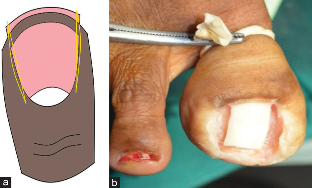 (a) Diagrammatic representation of wedge resection of lateral nail folds in a harpoon nail and (b) dorsal view of left hallux after excision of nail plate and nail fold.