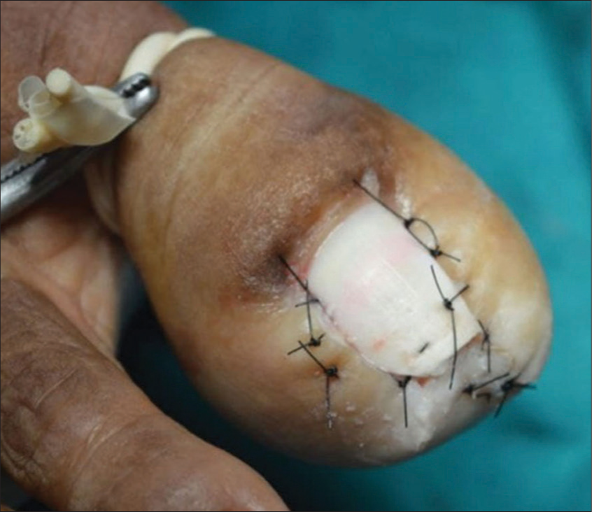 Immediate post-operative photograph after suturing of both lateral and distal folds.