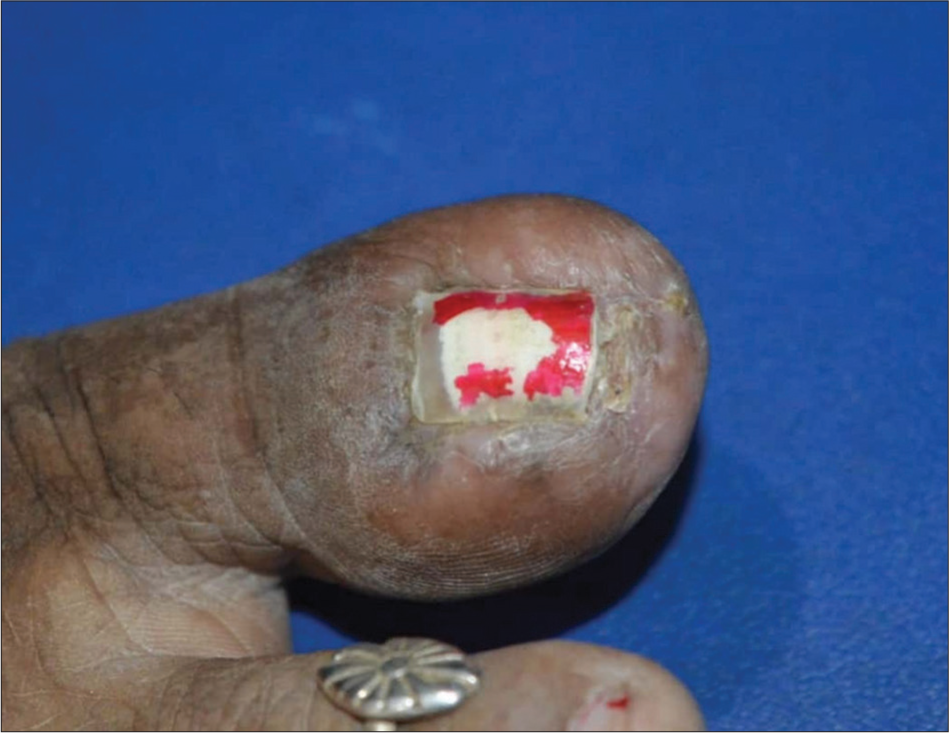 Post-operative photograph of the left hallux.