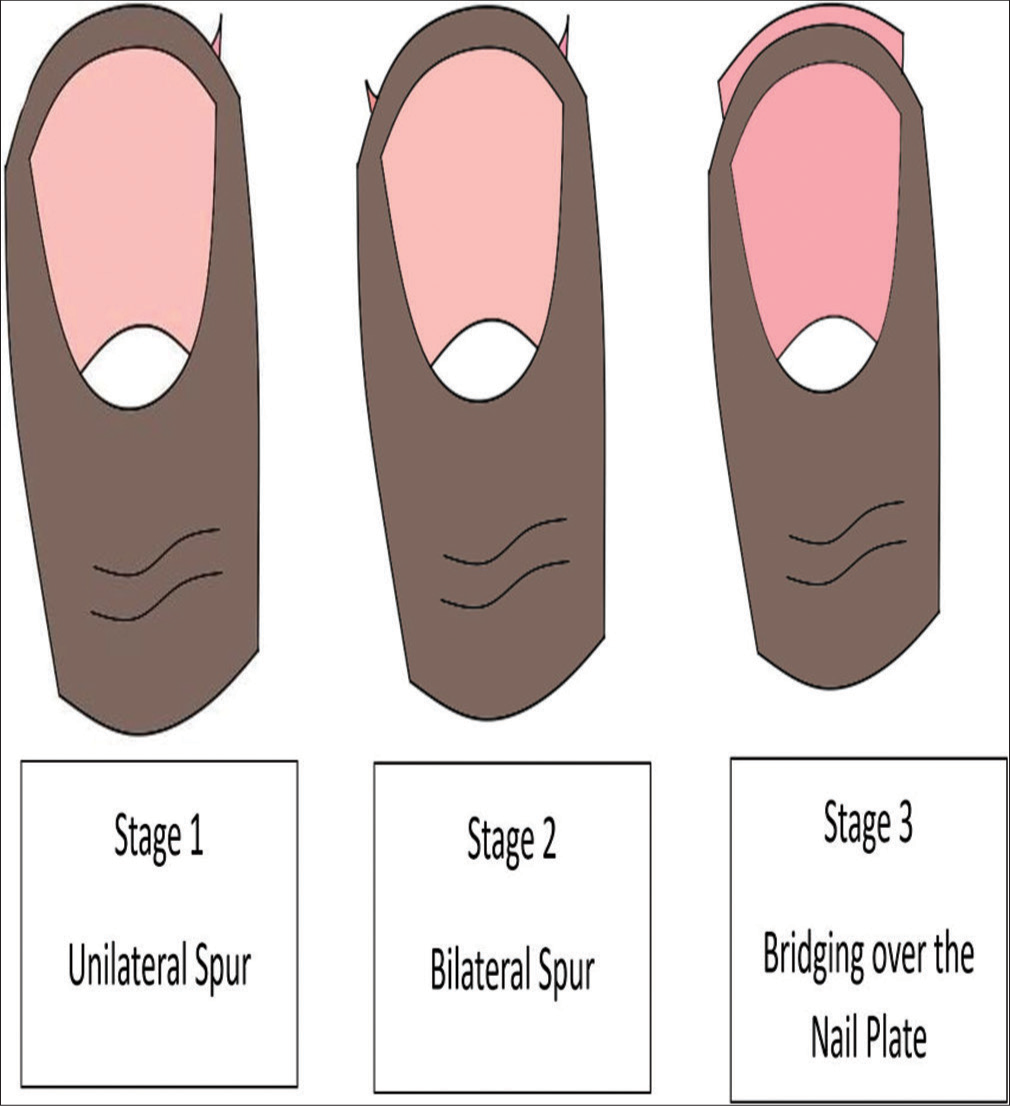 Harpoon nail staging system.