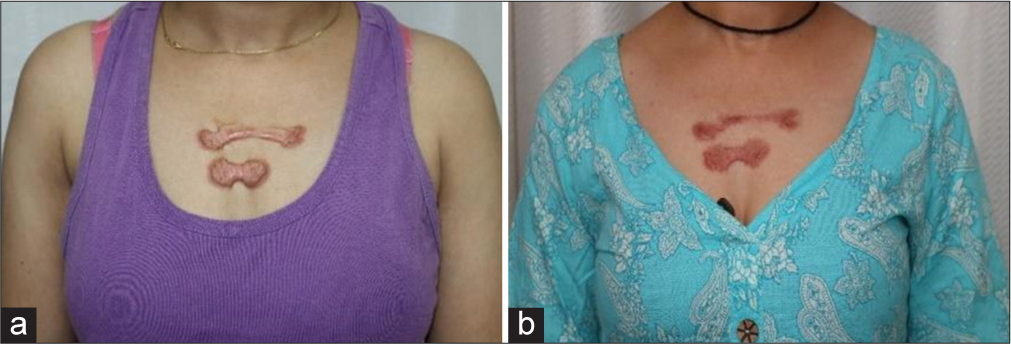 (a) A 45-year-old female with chest keloid for 2 years. (b) 62.5% reduction in modified vancouver scar scale (VSS) after 6 treatment sessions.