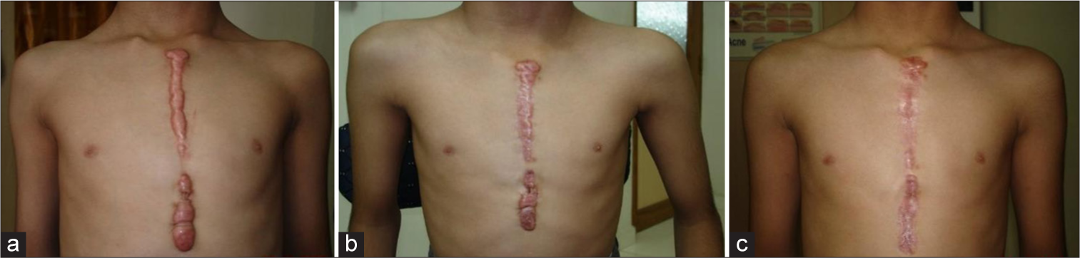 (a) A 14-year-old boy with extensive midline chest keloids (vancouver scar scale [VSS]: 12). (b) After 3 sessions of Erbium YAG laser with ILS. (c) VSS reduced to 4 after 6 sessions. YAG: Yttrium aluminium garnet, ILS: intralesional steroid.