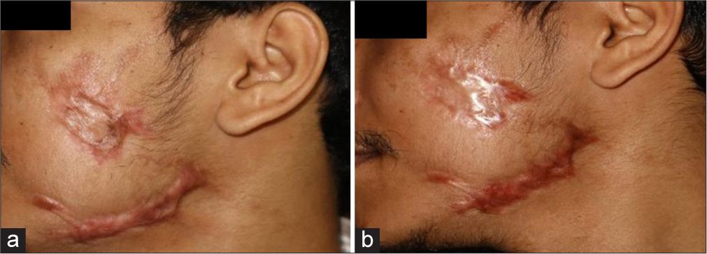 (a) A 31-year-old male with post-traumatic keloid over left cheek. (b) Reduction in vancouver scar scale (VSS) from 6 to 2 after 6 sessions.