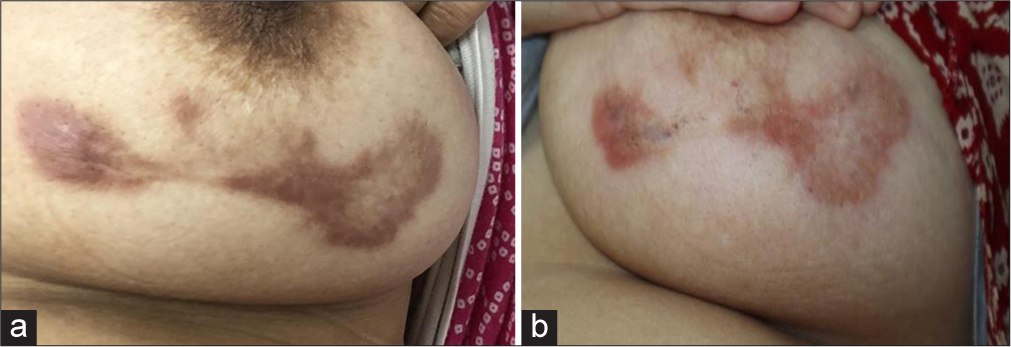 (a) A 40-year-old female with keloid over breast. (b) Significant reduction in erythema and induration after completion of treatment.