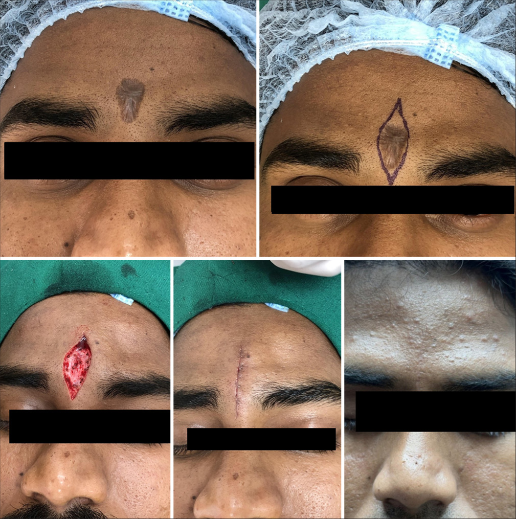 Traumatic scar over the glabella excised vertically (against relaxed skin tension line), resulting in complete recovery after 6 months.