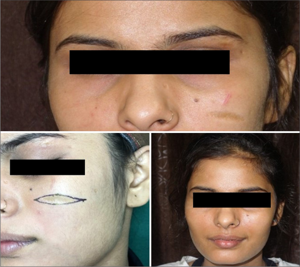 Post-traumatic scar over the left cheek, which was oriented horizontally was excised along its long axis.