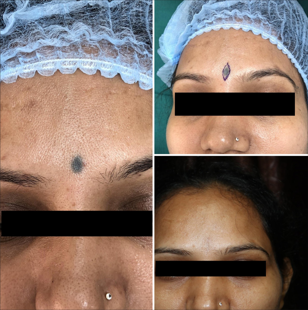 Elliptical excision of compound nevus, done against the relaxed skin tension line, resulting in an inconspicuous scar.