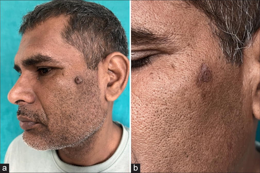 (a and b) Response on recalcitrant wart on the face after 1 laser session.