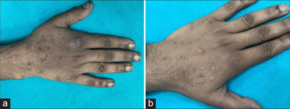 (a and b) Response on multiple warts on the dorsum of hand after 4 laser sessions.