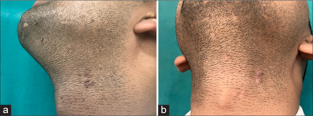 (a and b) Response on multiple recalcitrant warts on the neck after 1 laser session.