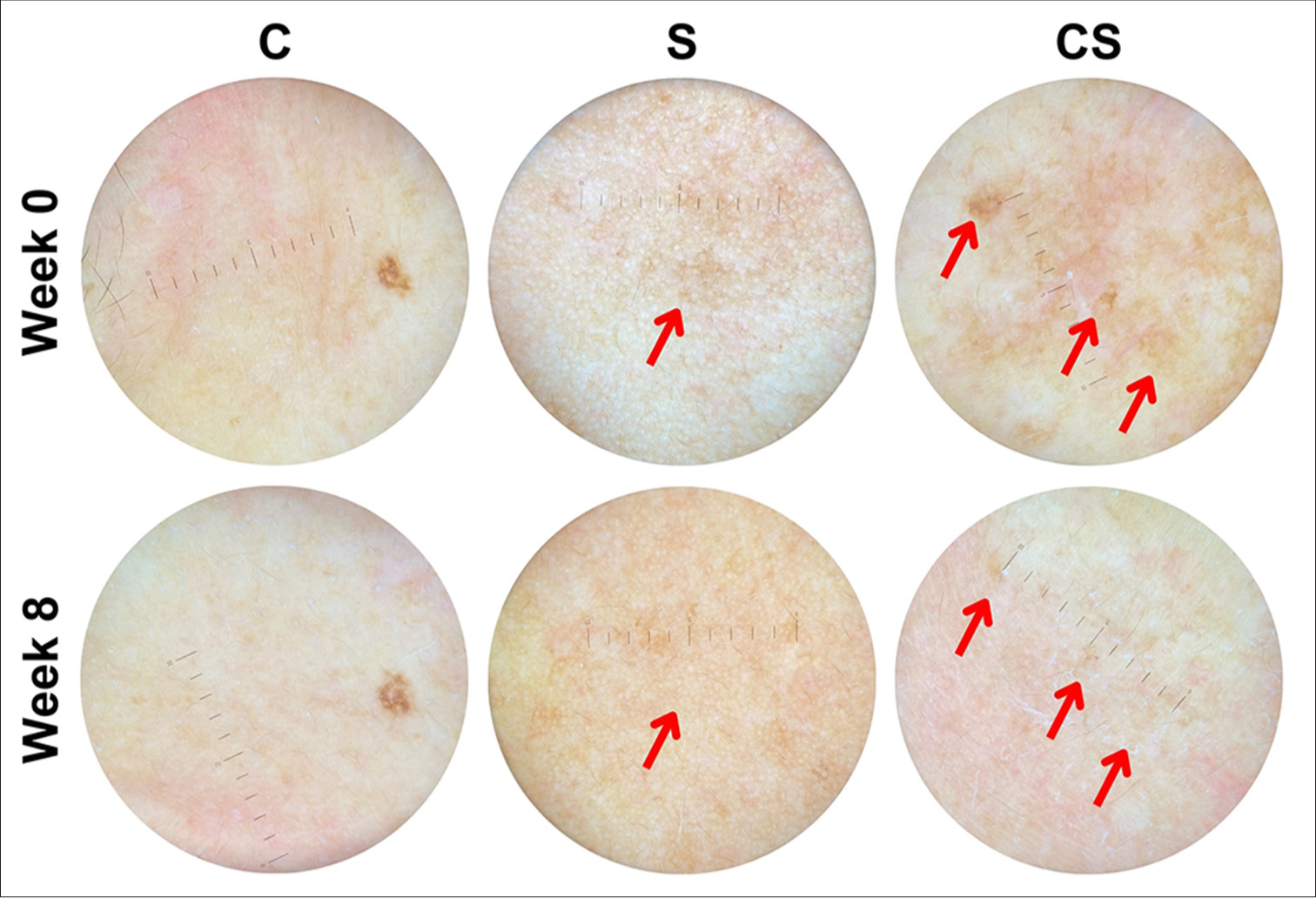 Dermoscopic representation of hyperpigmented macules (one of the observed skin aging signs) in subjects receiving 0.9% NaCl control (C), unconcentrated secretome (S), and concentrated secretome (CS) under ×10 magnifying power. Note the qualitative reduction of hyperpigmentation ().
