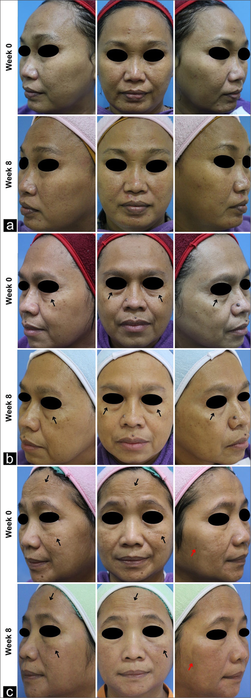 Clinical representation of skin aging features in subjects treated with (a) control (C), (b) unconcentrated secretome (S), and (c) concentrated secretome (CS). Note the qualitative diminution of hyperpigmentation () and observable wrinkles ().