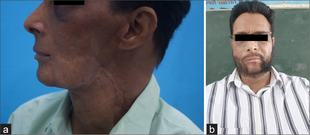 (a) Pre-operative photographs before undergoing beard transplantation. (b) 1 year after the surgery.