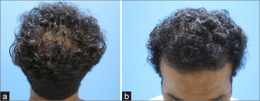 (a) Pre-operative photographs during the time of presentation. (b) Eight months after surgery.