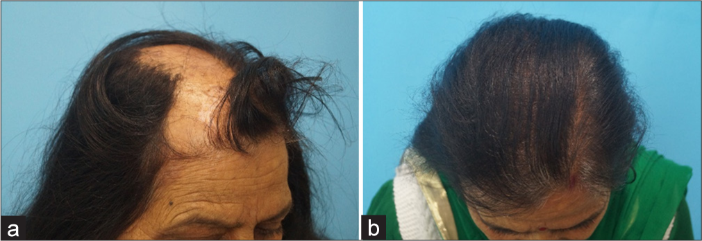 (a) Pre-operative pictures of the patient showing scarring alopecia. (b) Results after 1 year.