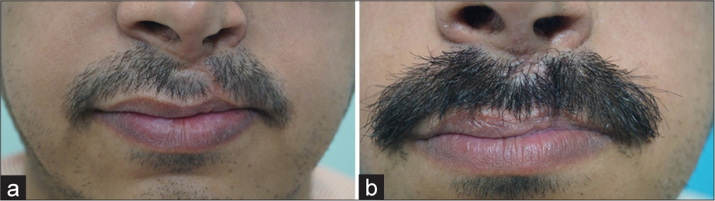 (a) Pre-operative pictures showing traumatic scarring alopecia. (b) 8 months after surgery.