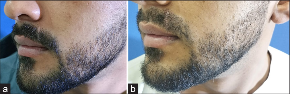 (a) Pre-operative picture. (b) 1 week post-surgery.