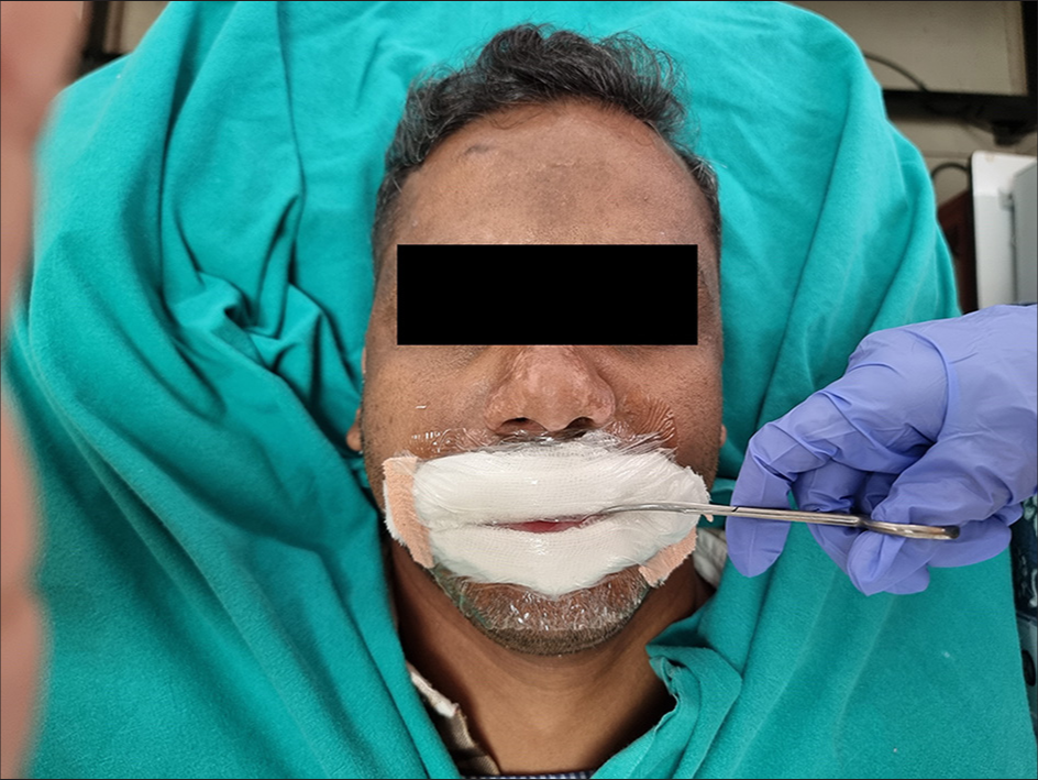 Three layered dressings applied over the lower lip in the smiley face direction and on the upper lip in the sad face direction and secured with an adhesive crepe bandage just beyond the angle of the mouth. A linear slit is being made over the adhesive transparent dressing.