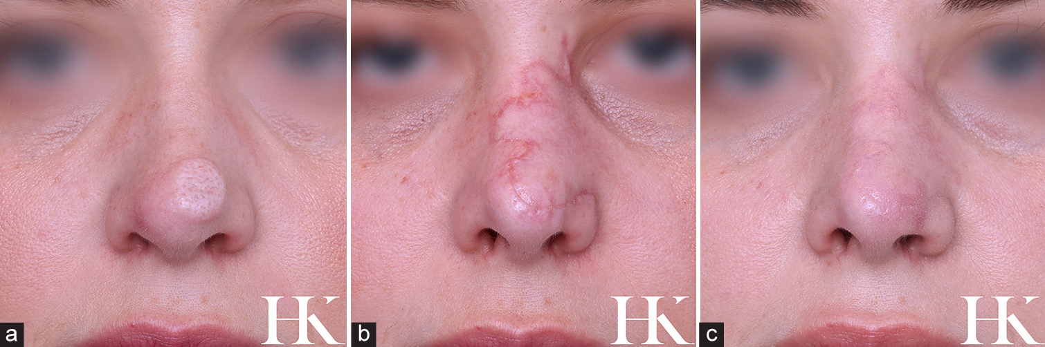 (a) Residual intradermal nevus and scar tissue on the left nasal tip following multiple unsuccessful removal attempts over 15 years. (b) Patient 6 weeks post excision and repair via Trilobe Flap. (c) Patient 5 months post scar resurfacing with fractional carbon dioxide laser, dermabrasion, and vascular laser treatment.