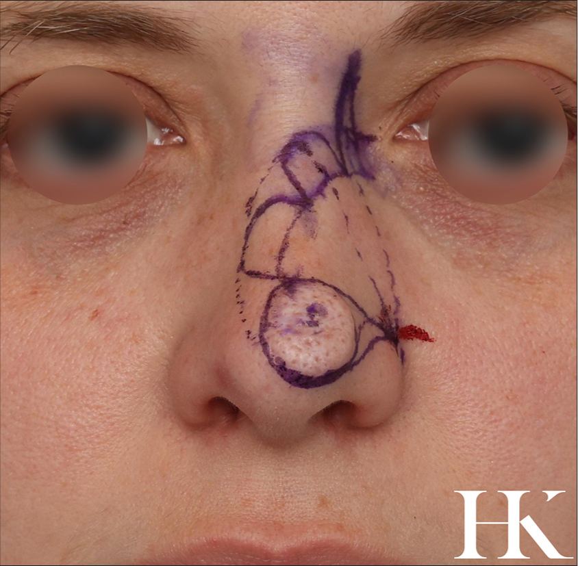 Preoperative markings and the design of the tri-lobe flap transposition flap.