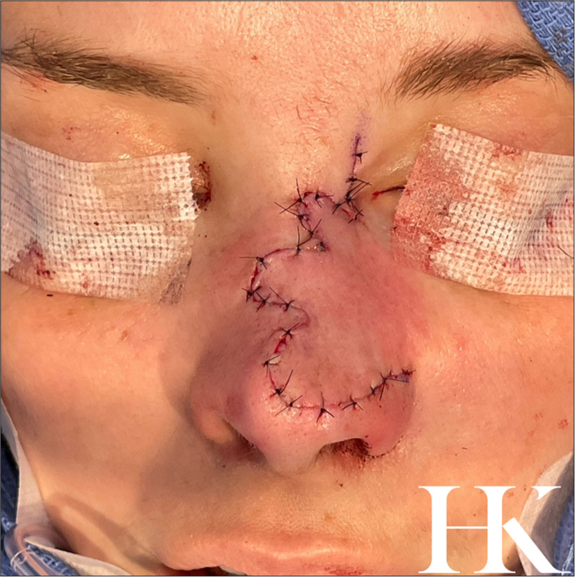 Patient immediately post-operative.