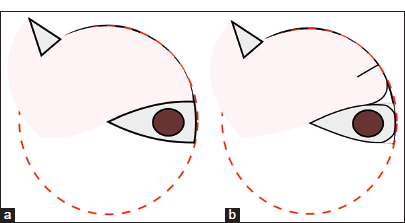 Direct comparison of the classical rotation flap design and the modification with flap incision. The extent of undermining of a rotation flap is shown in pink. (a) Common rotation flap. (b) Modified flap showing an incision of the flap at a distance approximately matching the width of the excision defect.