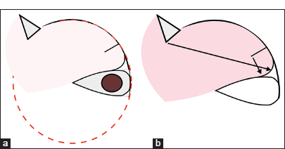 (a) The excision of the lesion is drop-shaped with only one sharp angle at the pivot point of the rotation. (b) The line of maximum tension of the flap (black arrow) shows that there is no sharp-angled flap tip.