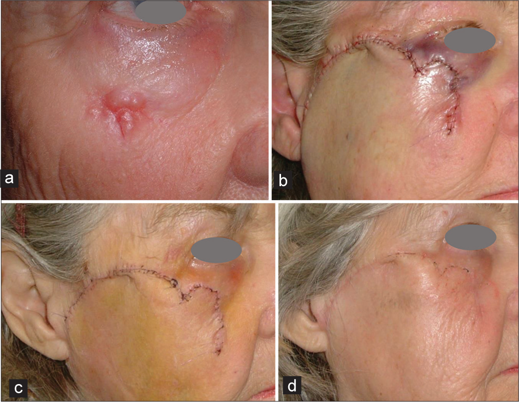 Large basal cell carcinoma of the right zygoma in an 84-year-old female patient. (a) Preoperatively. (b) End of Mohs surgery and defect repair with a modified cheek rotation flap. (c) One week after surgery, with a rotation flap with a notch. (d) Four weeks after the operation.