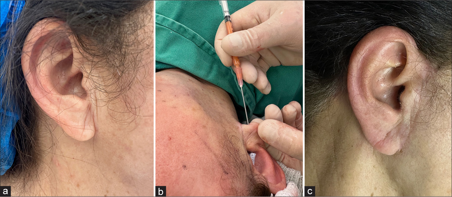 (a) Atrophic and wrinkled earlobe. (b) Fat grafting into the earlobe during rhytidoplasty. (c) Result 3 months after the procedure.