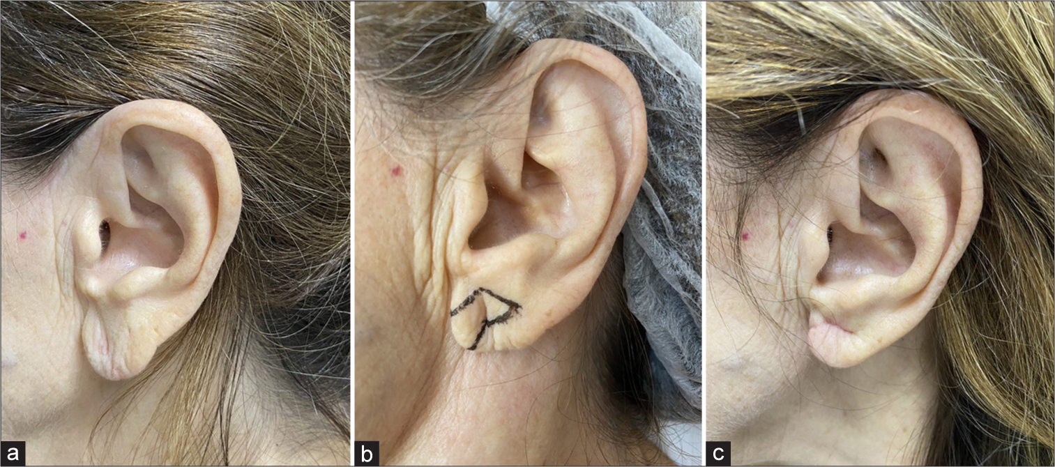 (a) A 61-year-old patient with ptosis and stretching of the earlobe. (b) Surgical planning. (c) Result 1 month after surgical procedure.