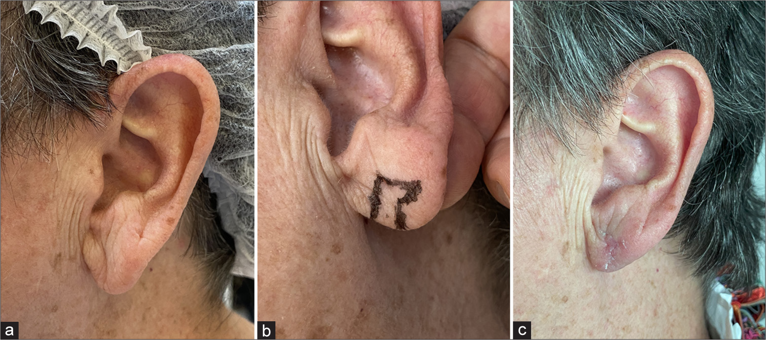 (a) Elongated earlobe in a 72-year-old patient. (b) Planning of surgical resection and reconstruction flaps. (c) One month postoperatively with esthetic improvement.