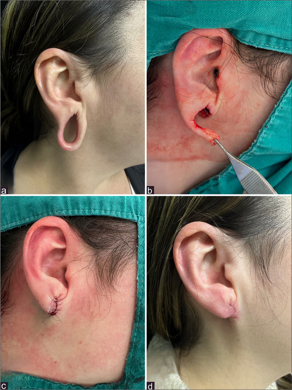 34-year-old patient, who has been using (a) earlobe gauging (rings) for 20 years. (b) Preparation of a local flap, de-epithelization of the inner rim of the hole. (c) Flap positioned and sutured. (d) Result 1 month after surgery (Henderson-Malata technique).