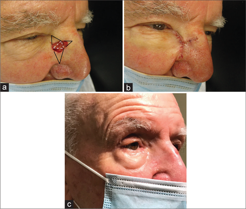 (a) Right nasal sidewall defect, resulting from treatment of basal cell carcinoma (BCC). Black lines represent Burow’s triangles; white dotted lines demonstrate approximate locations of initial key suture placement. (b) Immediate postoperative, no ectropion noted. (c) Eleven-month postoperative photo for 90-year-old man.