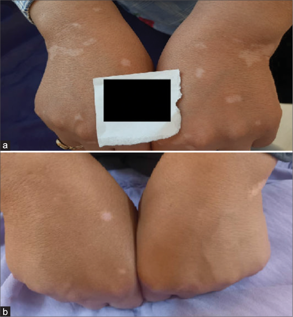 (a) Clinical photographs of a 51-year-old female with refractory vitiligo lesions on both hands before treatment and (b) six months after the final treatment session. The patient’s right hand treated with a combination of fractional carbon dioxide (FCO2) laser, excimer lamp therapy, and platelet-rich plasma demonstrates >75% repigmentation. The patient’s left hand was treated with a combination of FCO2 laser, excimer lamp therapy, and topical tacrolimus 0.1% shows between 50% and 75% repigmentation.