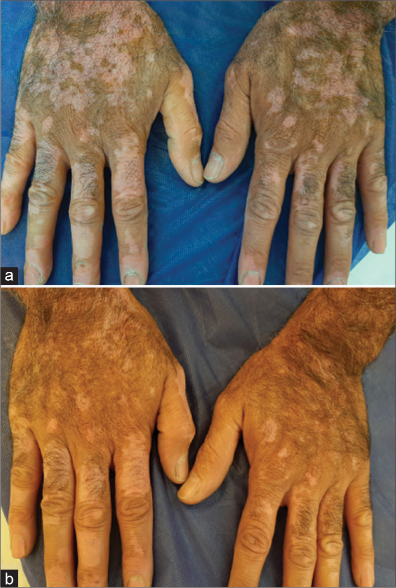 (a) Clinical photographs of a 56-year-old male with refractory vitiligo lesions on both hands before treatment and (b) six months after the final treatment session. The patient’s right hand treated with a combination of fractional carbon dioxide (FCO2) laser, excimer lamp therapy, and platelet-rich plasma demonstrates >75% repigmentation. The patient’s left hand was treated with a combination of FCO2 laser, excimer lamp therapy, and topical tacrolimus 0.1% shows between 50% and 75% repigmentation.