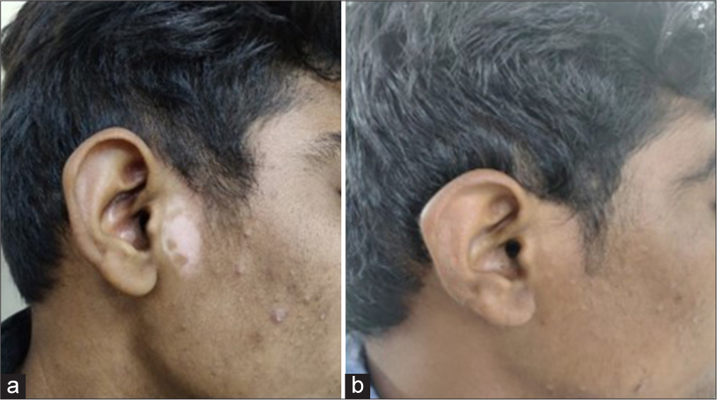 Patient treated by fractional Co2 laser with potent topical corticosteroid - (a) baseline visit (b) at or after 3 months.