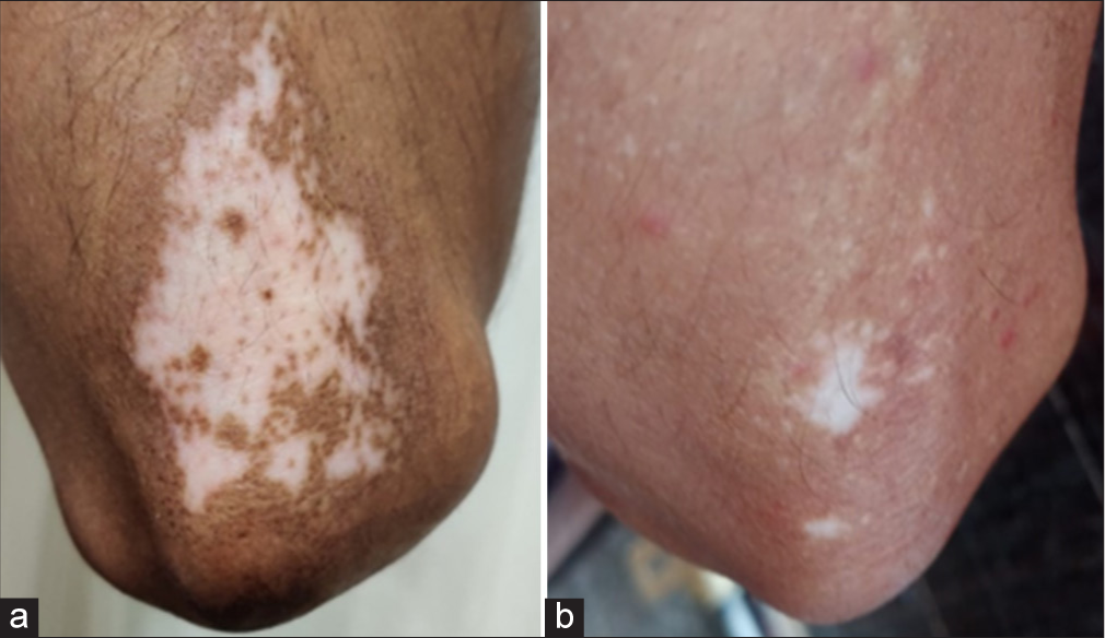 Patient treated by fractional CO2 laser with potent topical corticosteroid - (a) baseline visit (b) at or after 3 months.