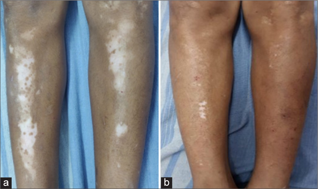 Patient treated by potent topical corticosteroid alone - (a) baseline visit (b) at or after 3 months.