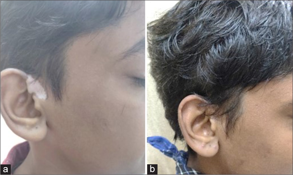 Patient treated by potent topical corticosteroid alone - (a) baseline visit (b) at or after 3 months.