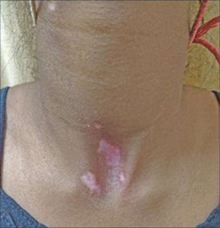 Case 2/Female/14 years with erythema.