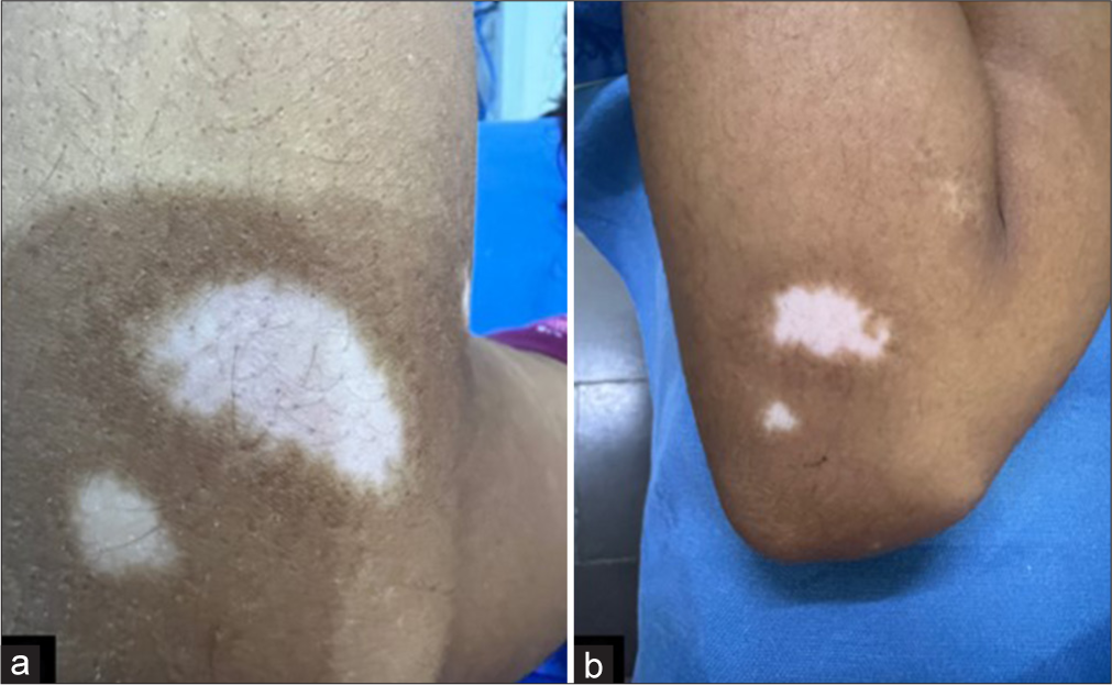 (a) Pre-procedure and (b) post-procedure image after 3 months of follow-up with grade 2 (25–50% repigmentation) improvement, marginal pattern of repigmentation, and same color match.