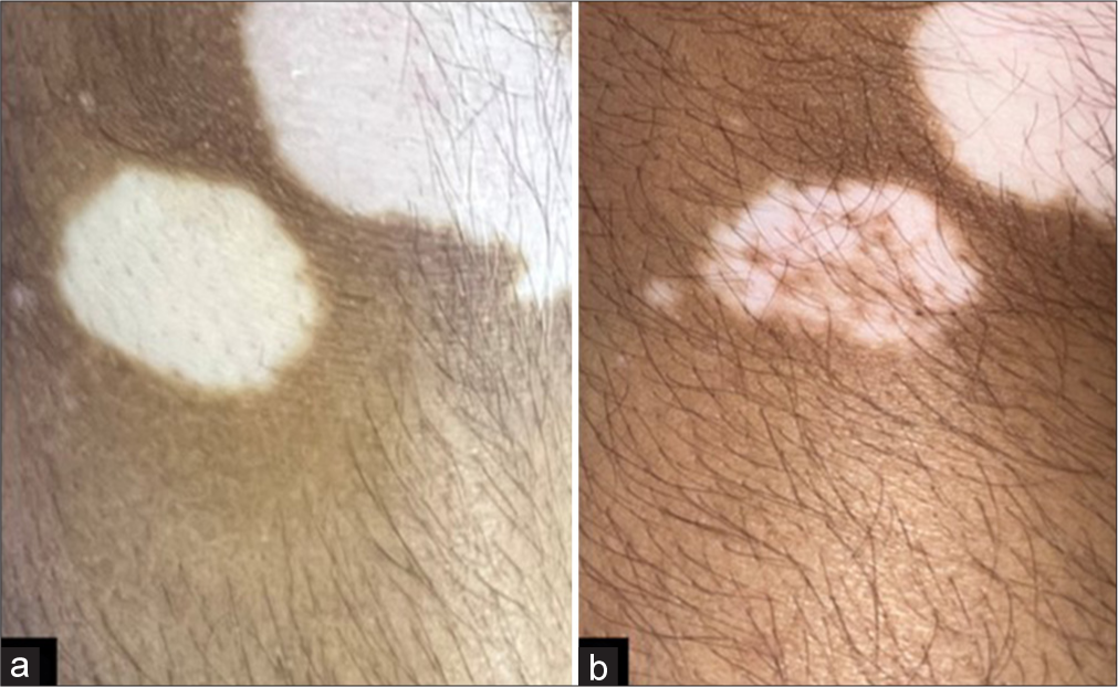 (a) Pre-procedure and (b) post-procedure image after 3 months of follow-up with grade 2 (25–50% repigmentation) improvement, dotted pattern of repigmentation, and same color match.