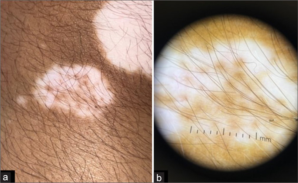 (a and b) Increased number of dots seen on dermoscopy when compared to naked eye examination (a) 16 dots on naked eye examination and (b) 22 dots seen on dermoscopic examination (DermLite DL4, non-polarized, ×10 magnification).